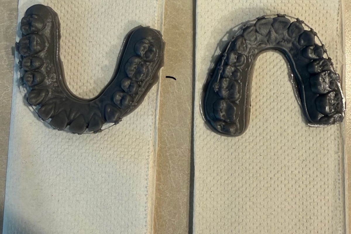 Two finished 3D-printed dental models