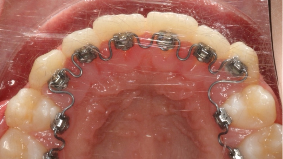Occlusal view of InSmile braces: brackets and Smartwire on the tongue side of the upper teeth