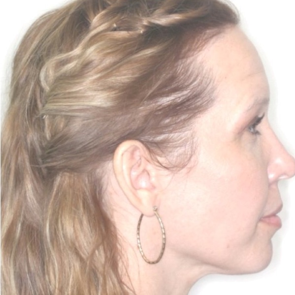 The same patient's side profile after lingual braces