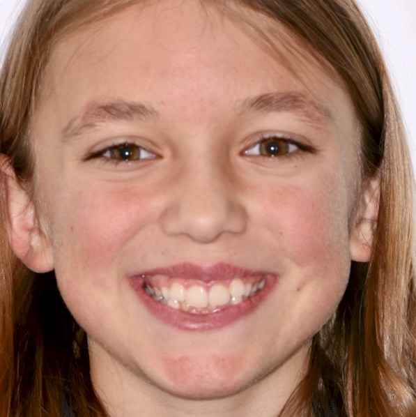 Child's smile before early treatment