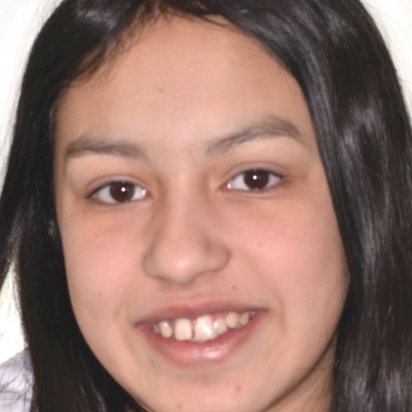 Teen patient's smile before treatment, with crowded front teeth