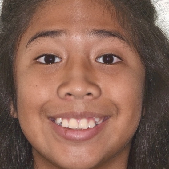 Patient's smile before treatment